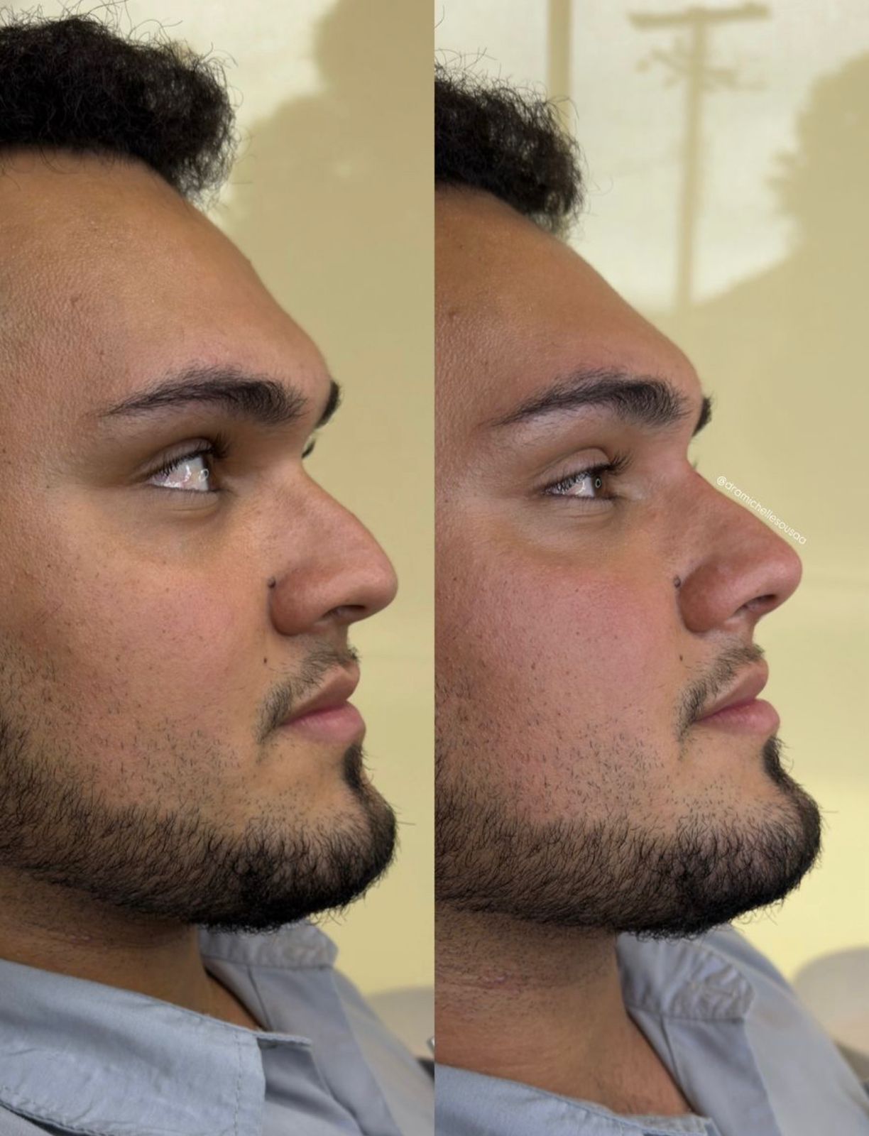Antes e depois — Rinomodelação