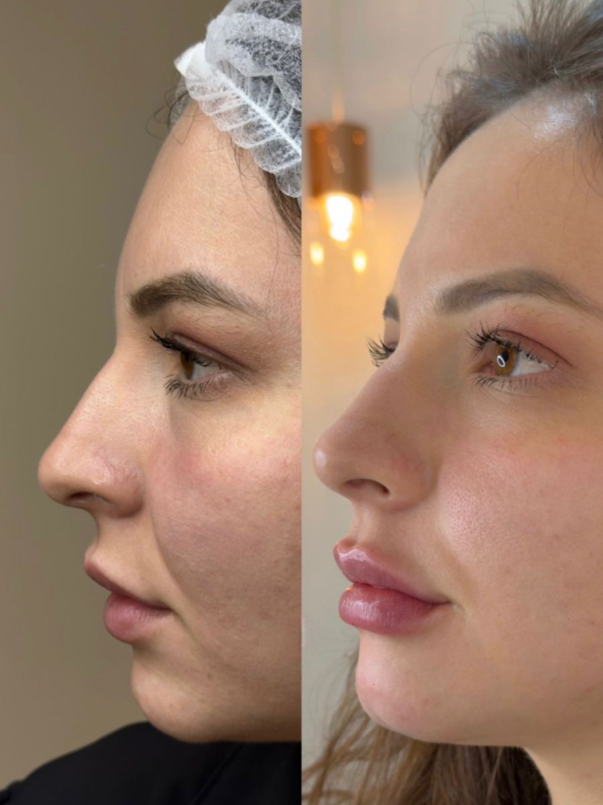 Antes e depois — Perfiloplastia