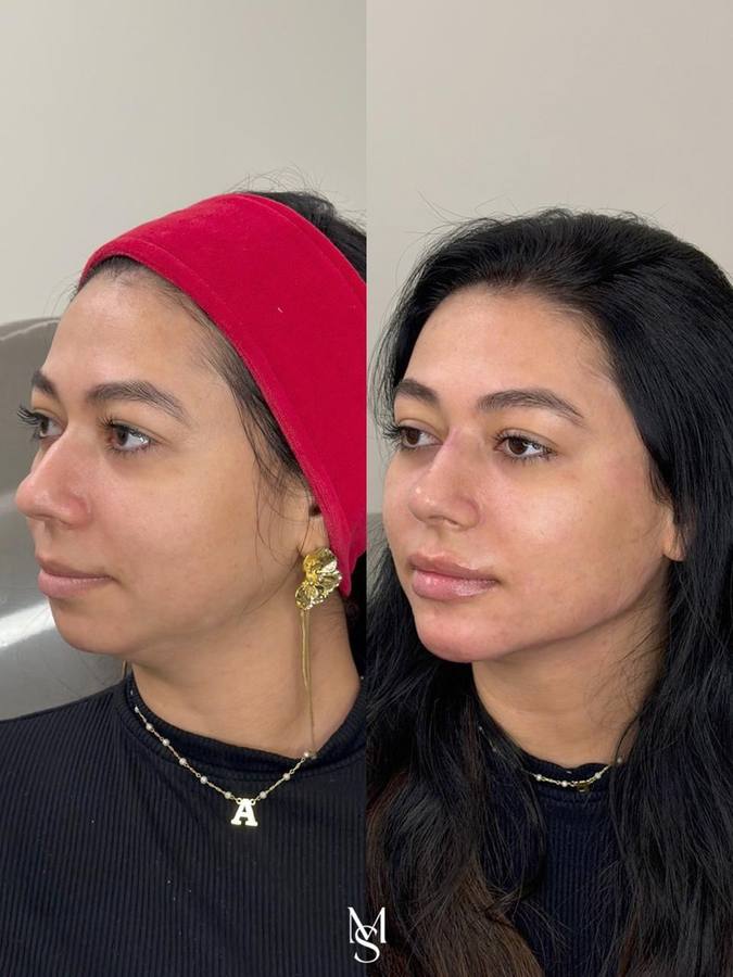 Antes e depois — Harmonização Facial