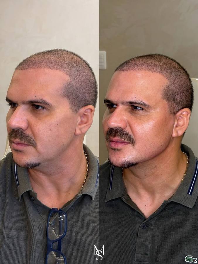 Antes e depois — Harmonização Facial