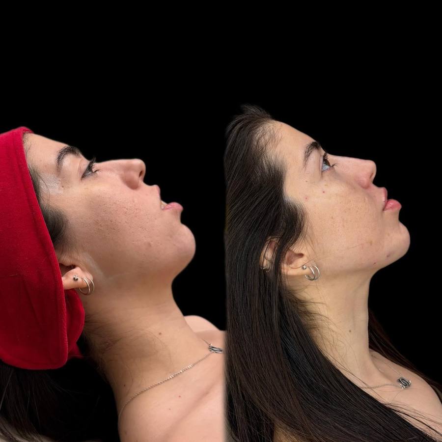 Antes e depois — Harmonização Facial