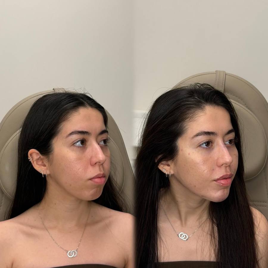 Antes e depois — Harmonização Facial