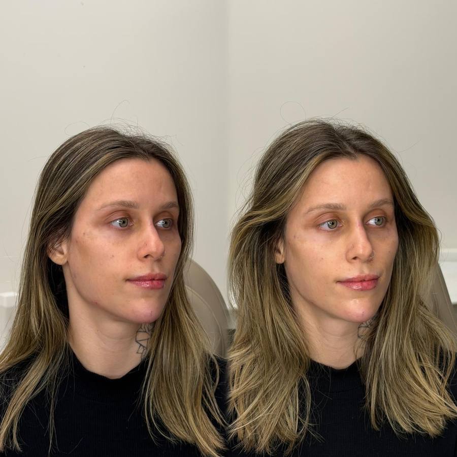 Antes e depois — Harmonização Facial