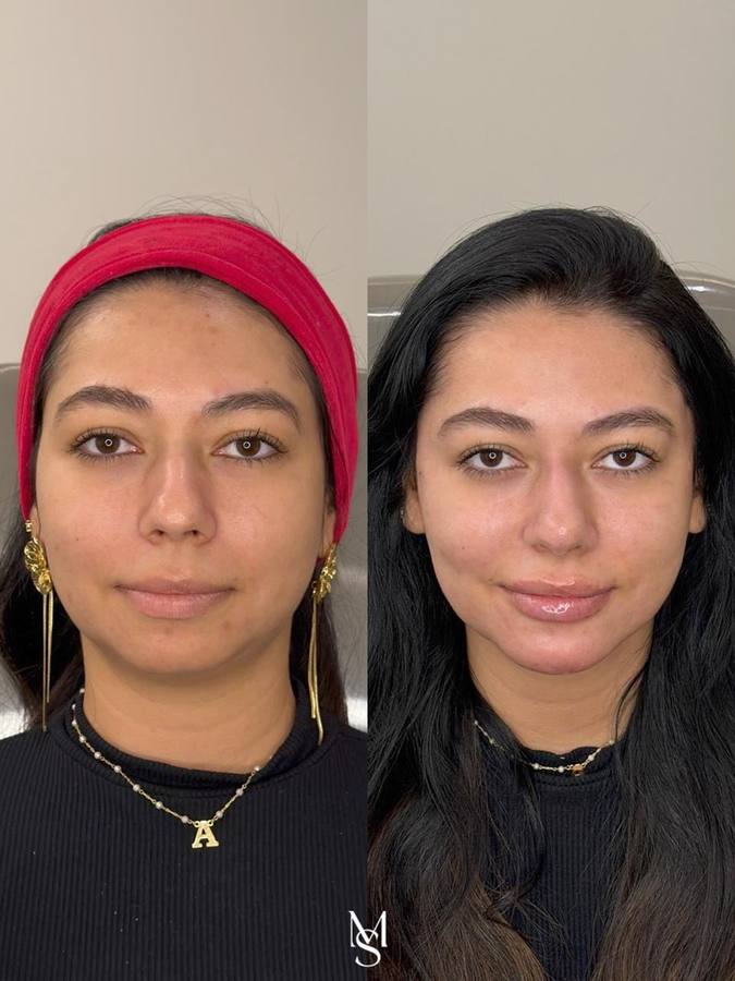 Antes e depois — Harmonização Facial